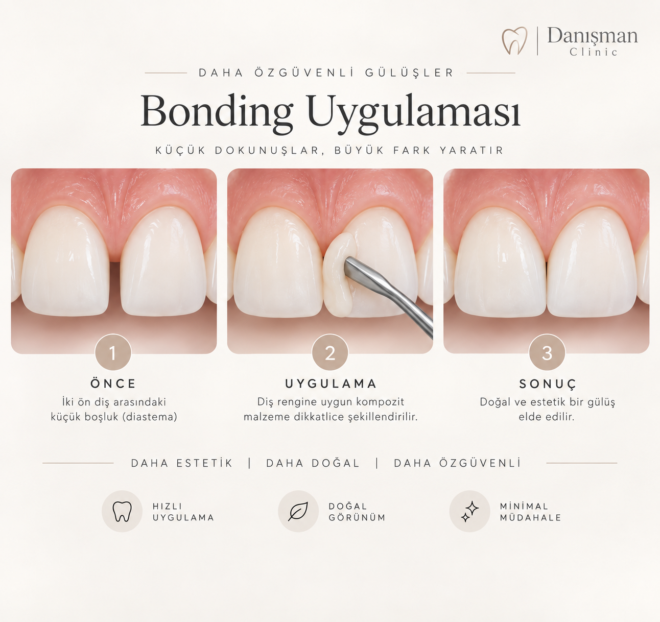 Bonding Uygulaması (Estetik Kompozit Dolgu)
